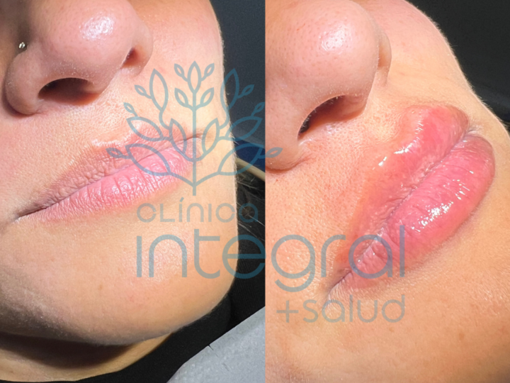Relleno y Perfilado de Labios con Ácido Hialurónico: El Toque de Juventud y Belleza